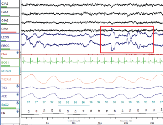 Viewing a polysomnogram